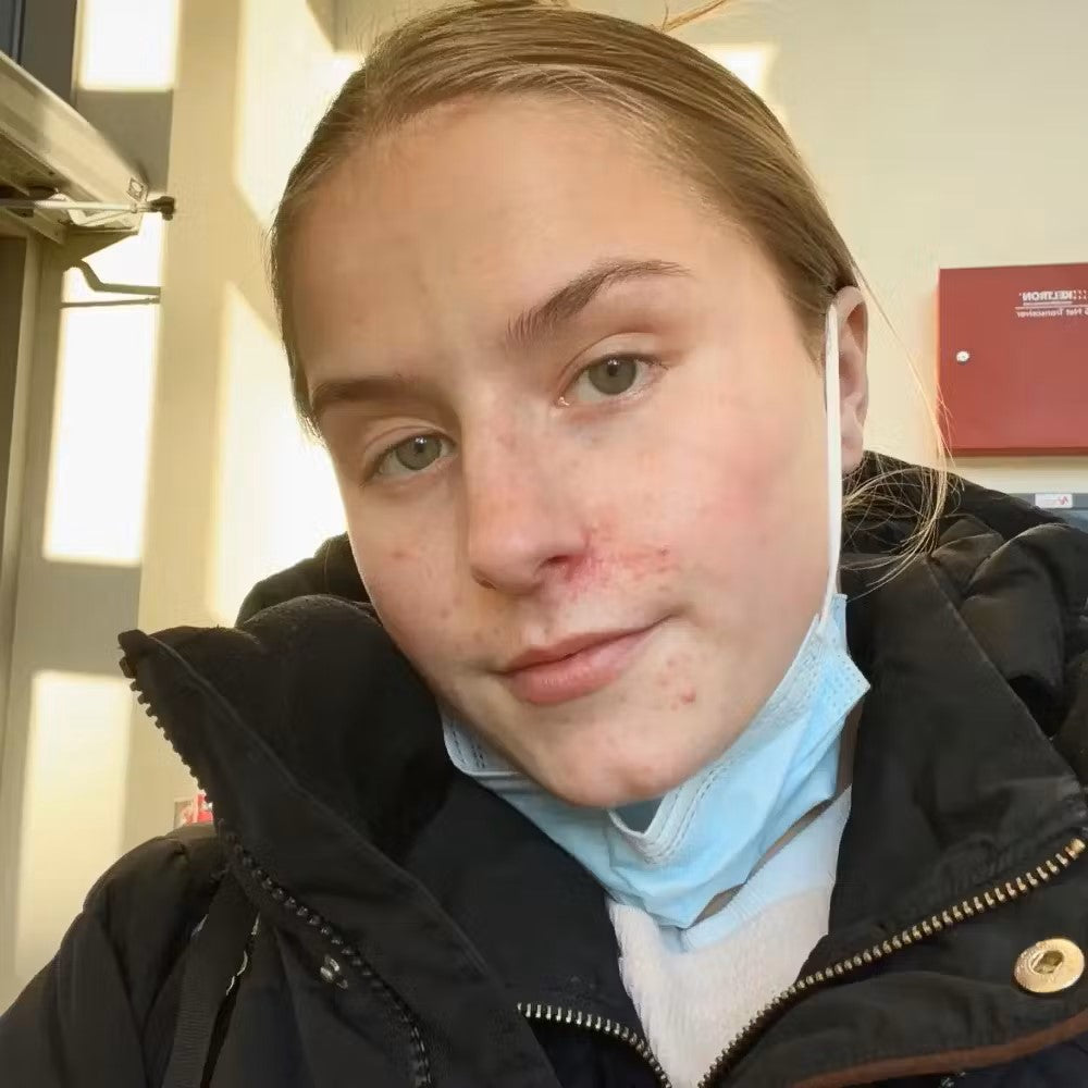 Kure-health-rejuvion-health-acne_skin_before